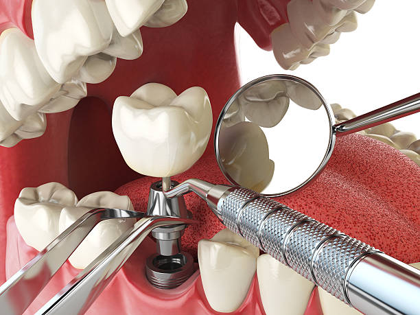 Best Knocked-Out Tooth Emergency  in Roxana, IL